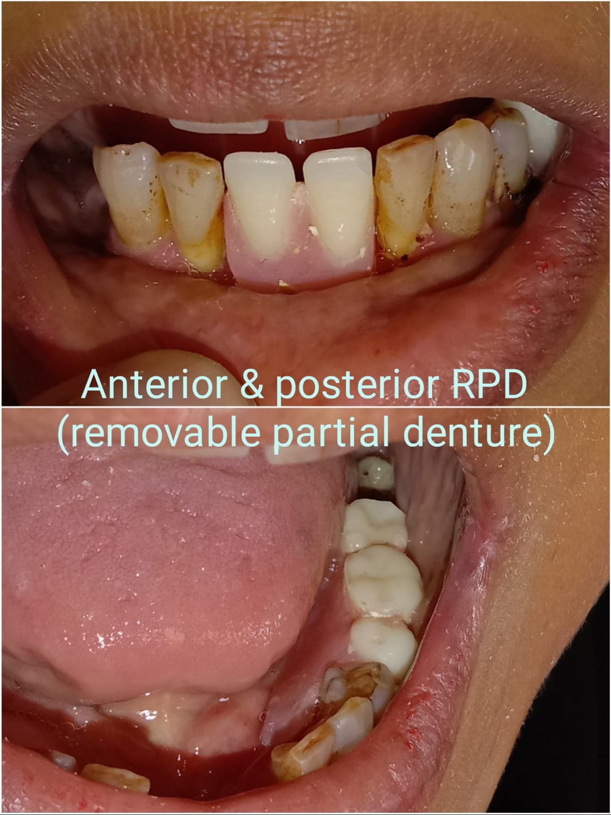 Anterior and posterior removable partial dentures replacing missing teeth in two close-up dental views.